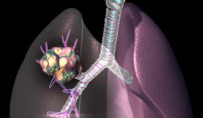 3D view of lung cancer I got from the <a href=